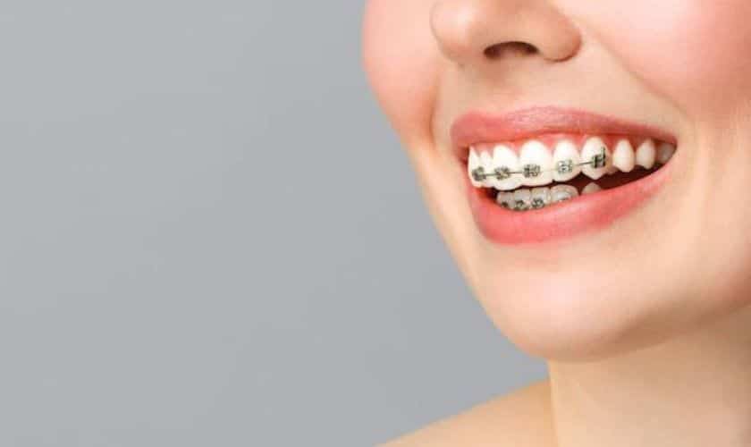 oral care with braces