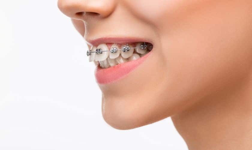 Braces