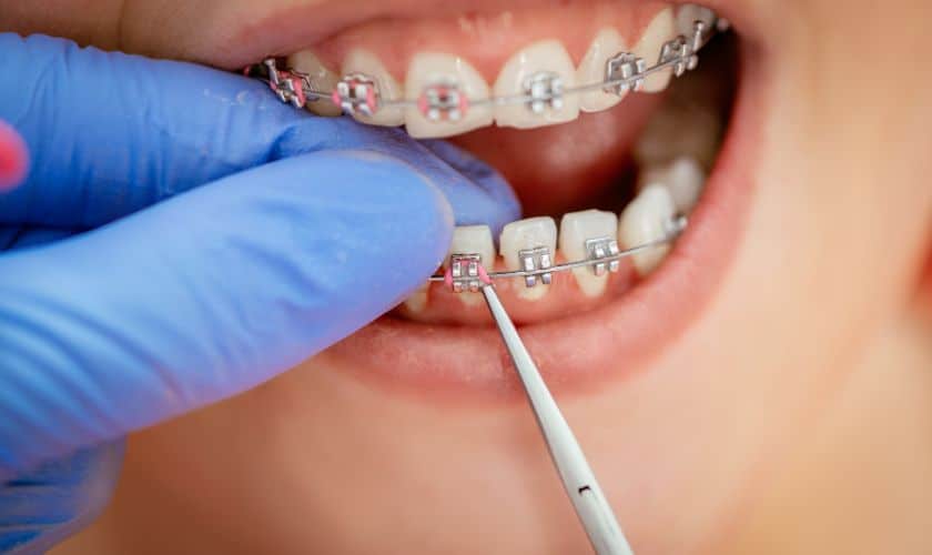 Braces