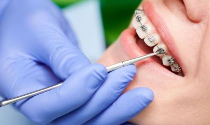 Braces 101: Your Guide to Orthodontic Treatment