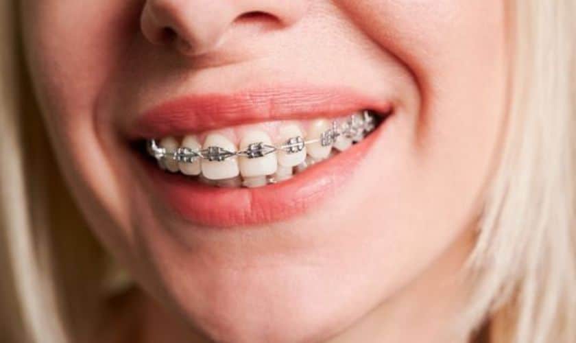 Braces in Merrick
