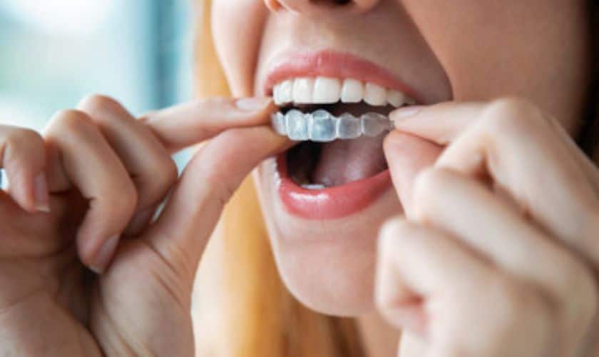 Invisalign in Jericho