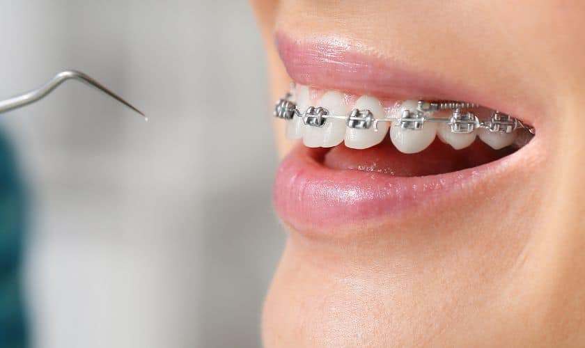Braces In Maspeth