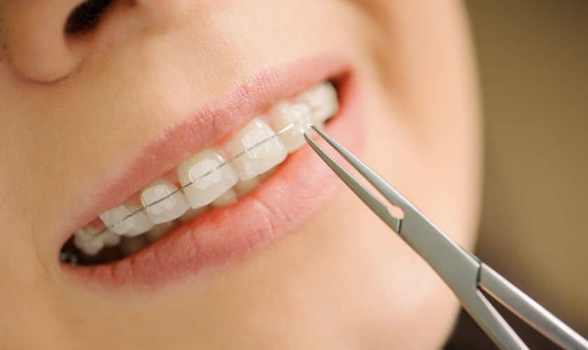 Braces In Maspeth