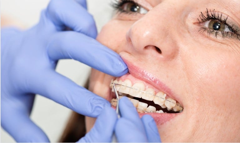 Braces in Jericho