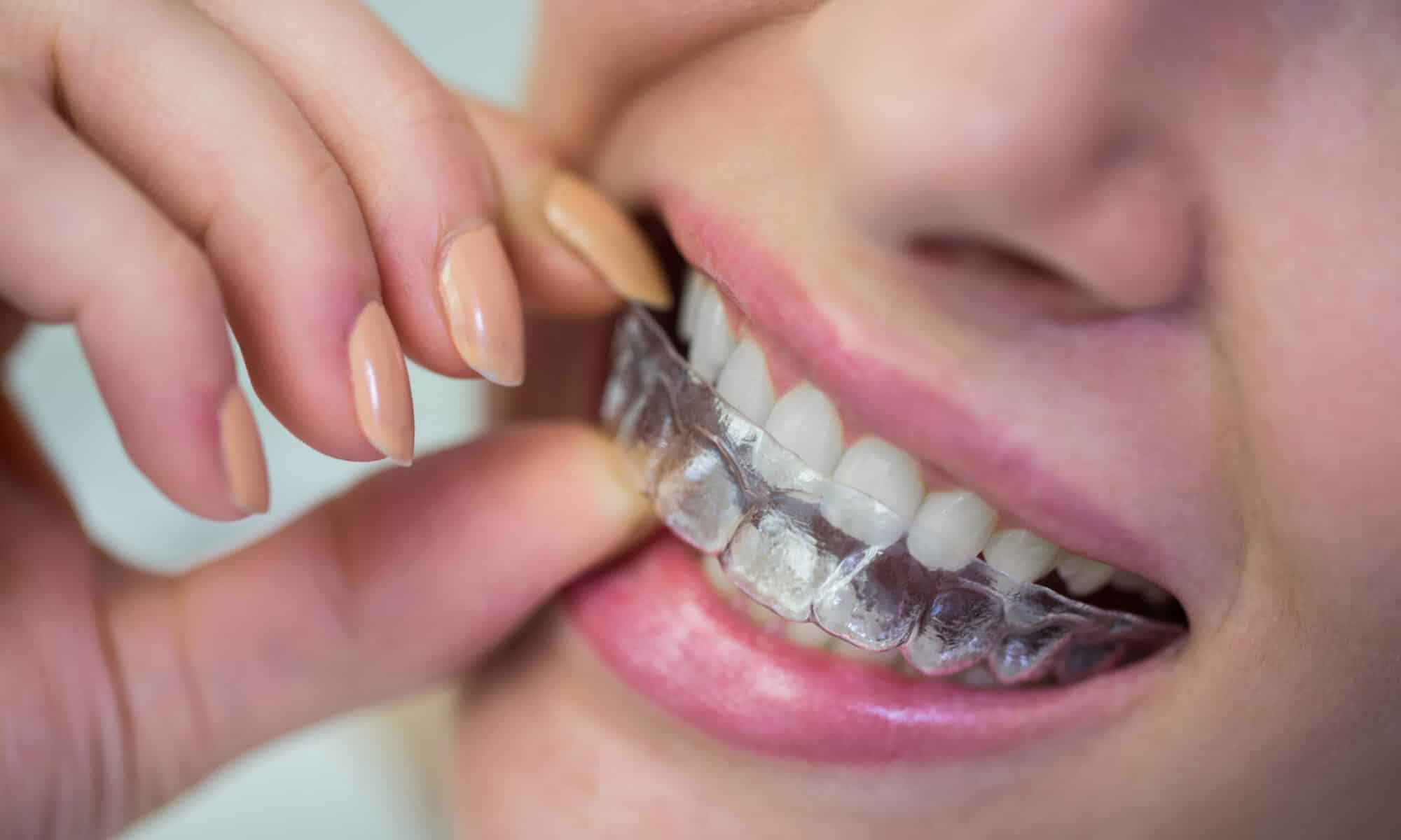 Invisalign In Merrick