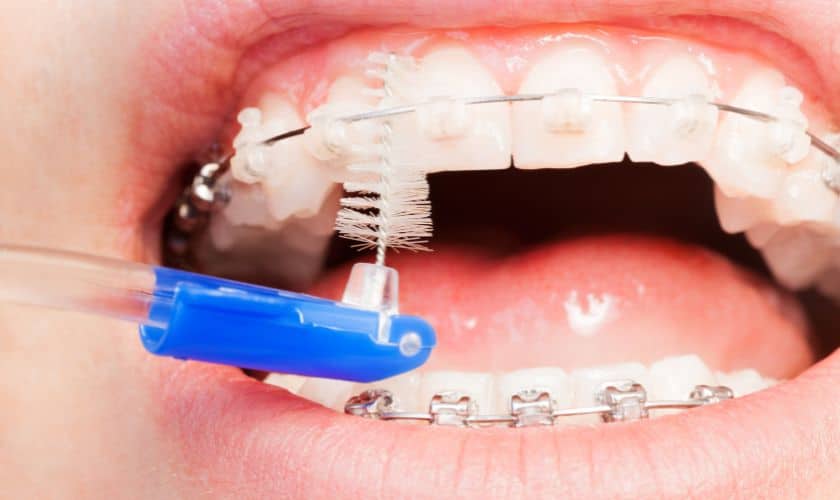 How Braces Align Your Teeth for a Better Bite