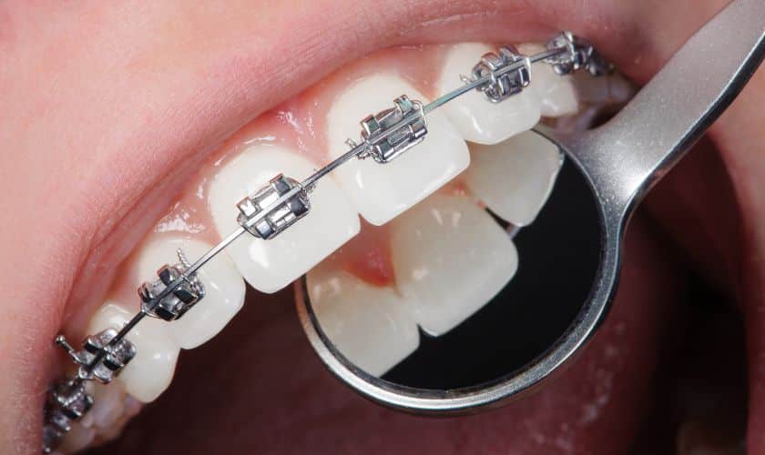 Braces in Jericho
