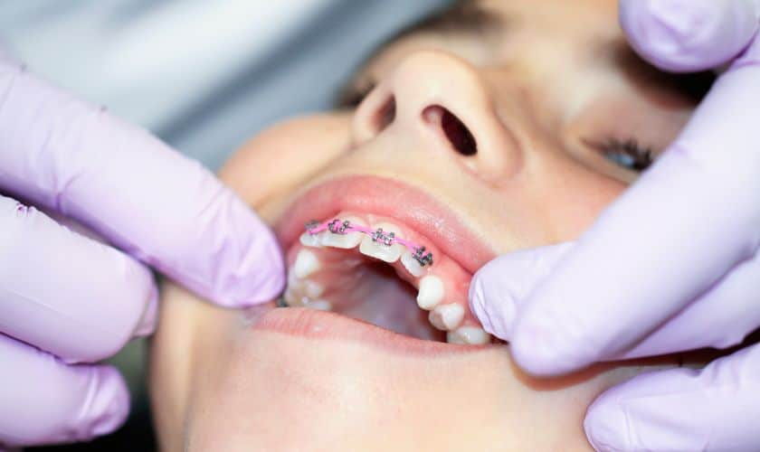 Braces near me