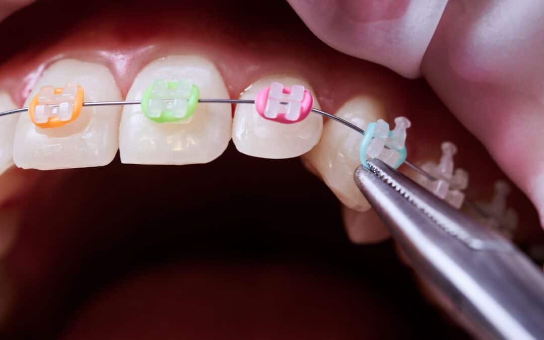 The Importance of Rubber Bands in Braces Care
