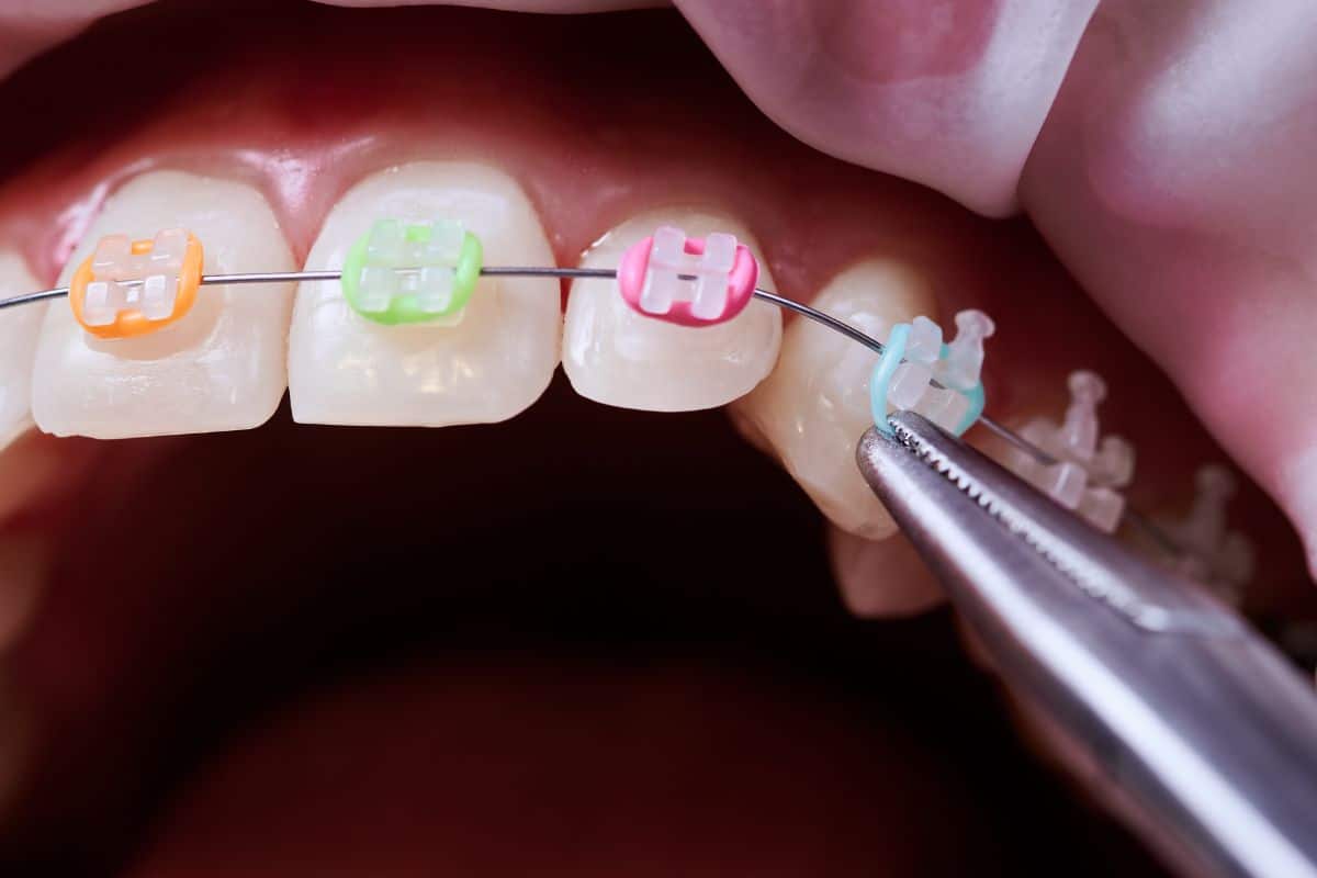 Rubber Bands in Braces Care
