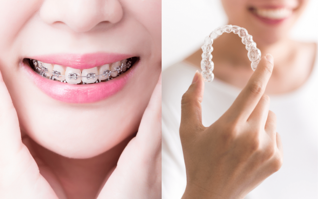 Invisalign vs. Braces: An Orthodontist’s Guide to the Perfect Smile