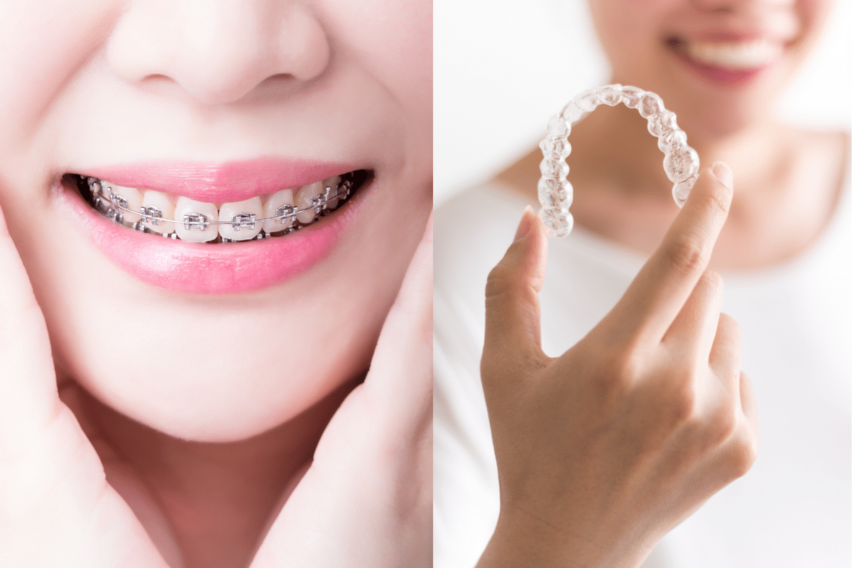 Invisalign or Braces: An Orthodontist in Merrick Weighs In