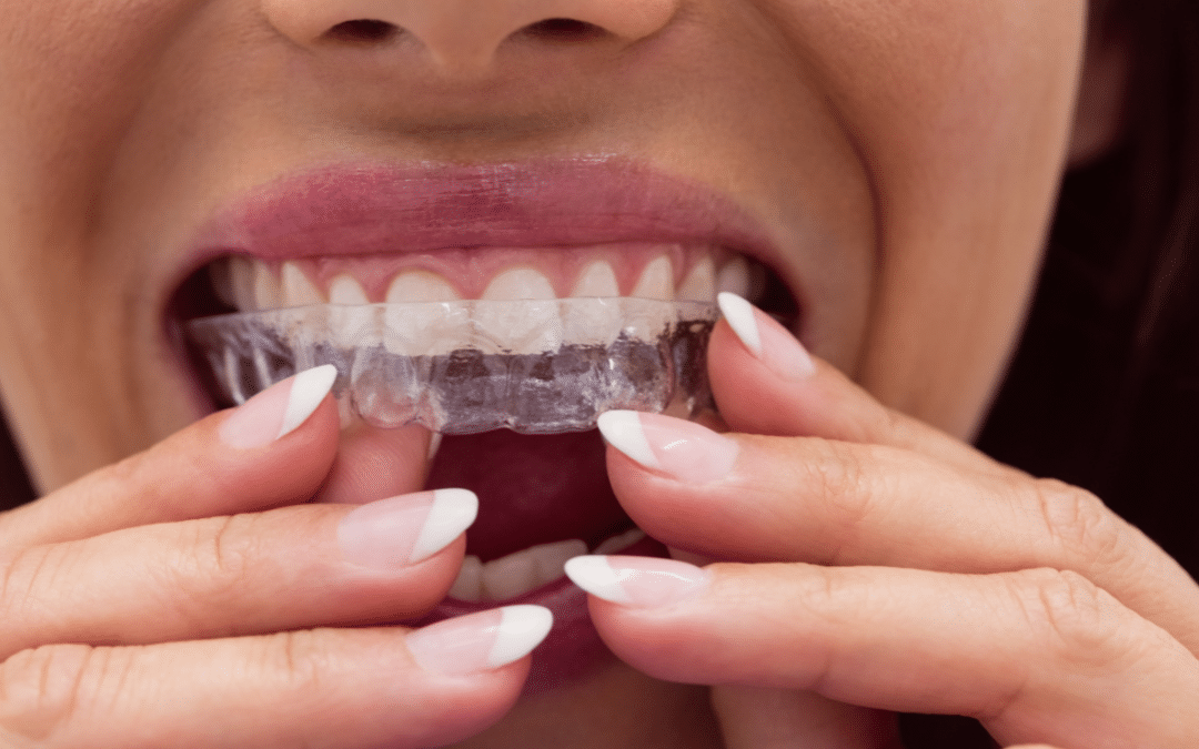 Is Your Speech at Risk with Invisalign? Uncover the Truth!