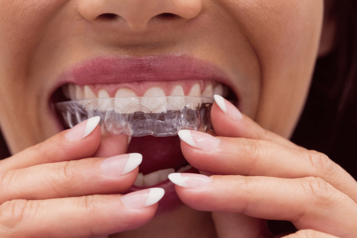 Is Your Speech at Risk with Invisalign? Uncover the Truth!