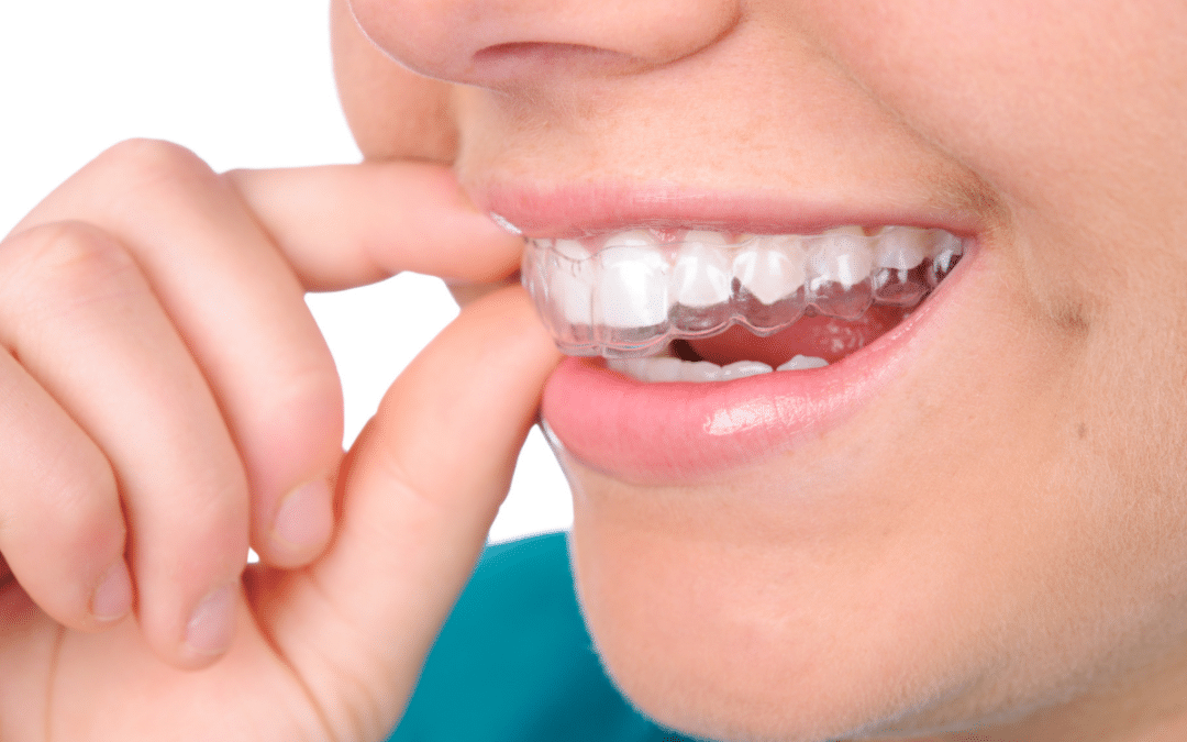 Why Your Orthodontist Recommends Retainers After Braces?