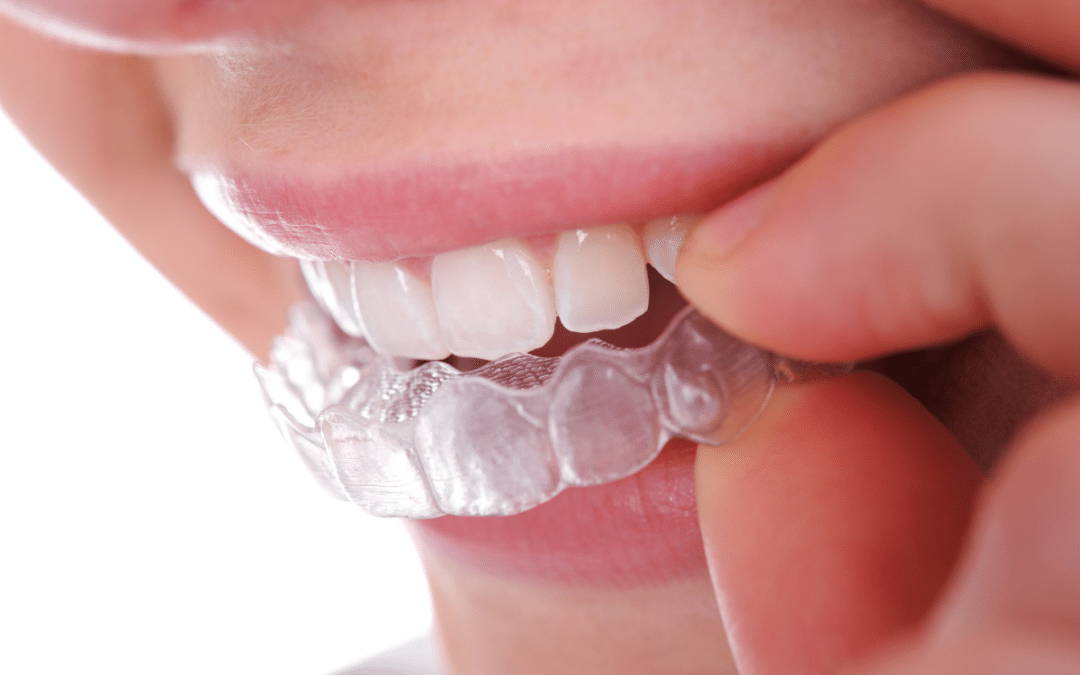 Do You Really Need to Wear a Retainer Forever After Invisalign?