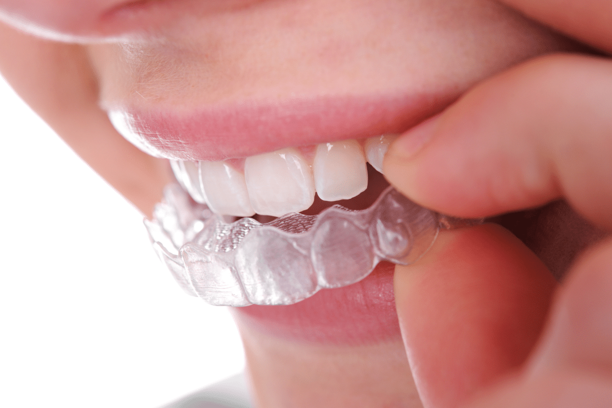 Do You Really Need to Wear a Retainer After Invisalign