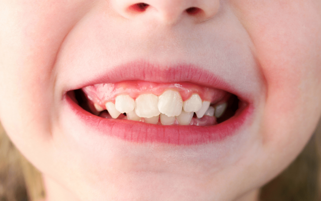 Common Orthodontic Problems and How to Fix Them