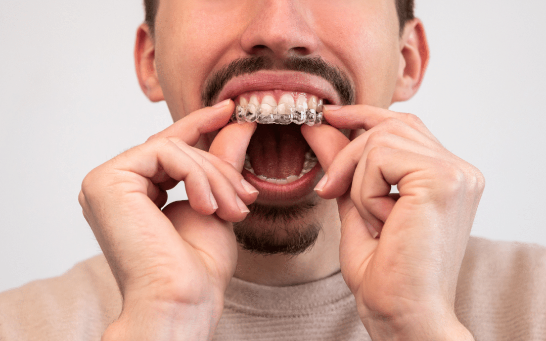 Is Invisalign the Right Choice for Adults? Here’s What You Need to Know!