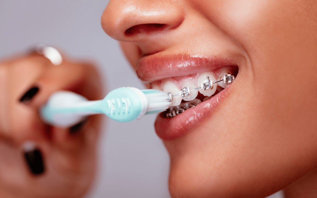 The Right Way to Brush with Braces: A Step Toward a Beautiful Smile