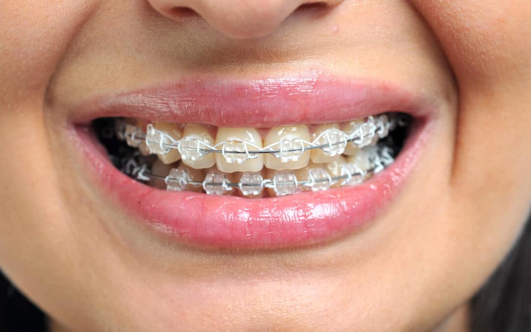 Braces Just Tightened? Hereās How Long the Discomfort Usually Lasts