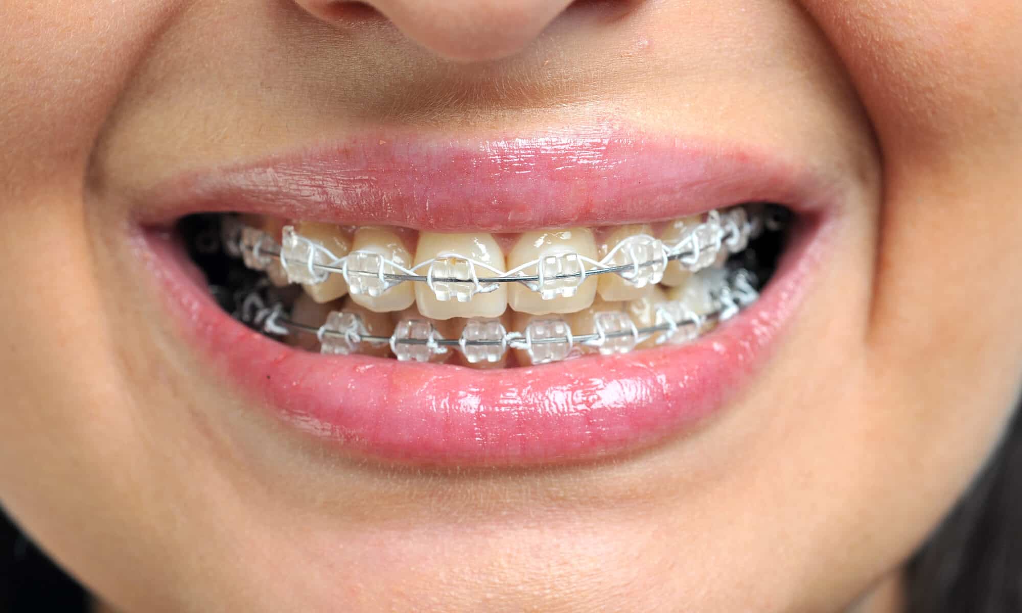 orthodontists in merrick explains how to get rid of the pain after braces tightening