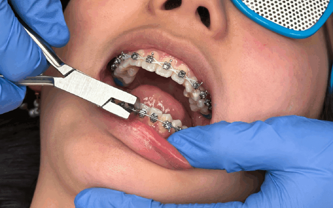 Why Braces Tightening Causes Discomfort and How to Ease It