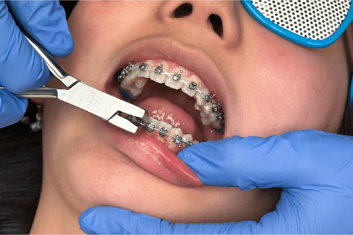 braces tightening pain relief by orthodontist merrick