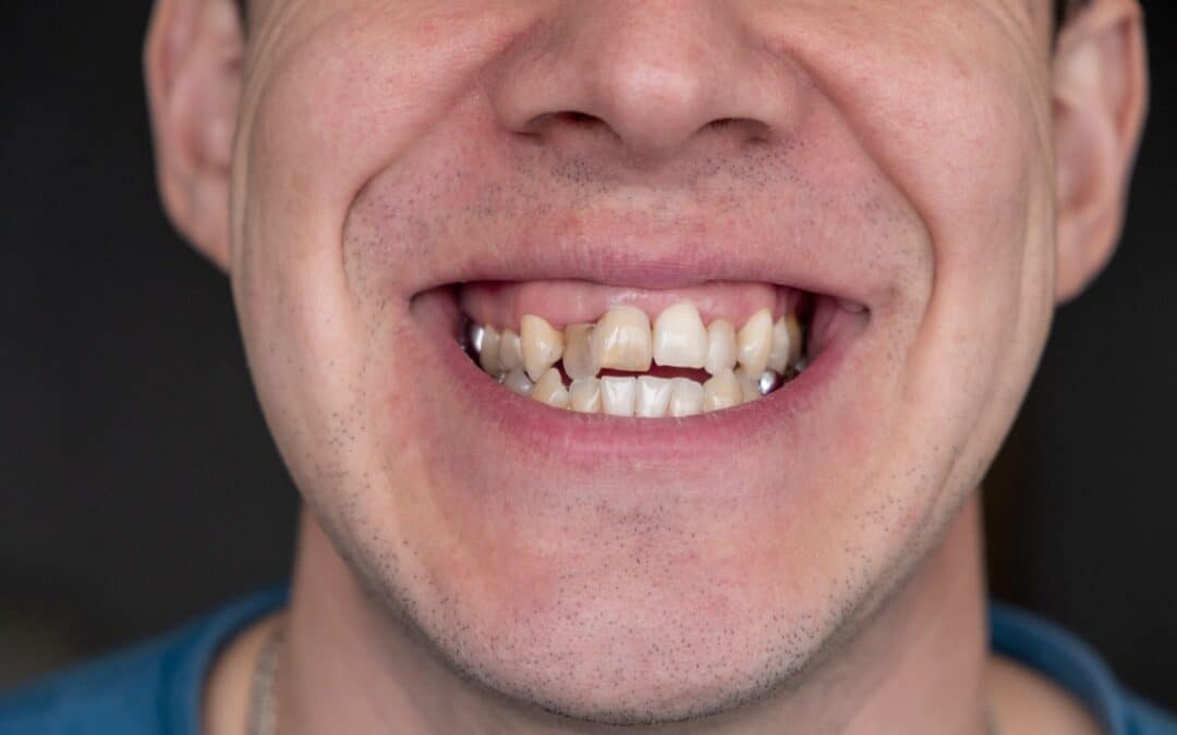 How to Know If Your Bite Is Off and When to See an Orthodontist