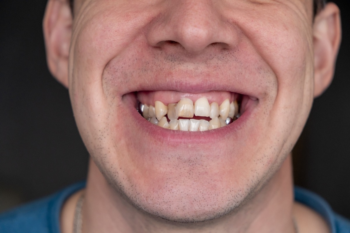 Crooked teeth dentist or orthodontist in Jericho