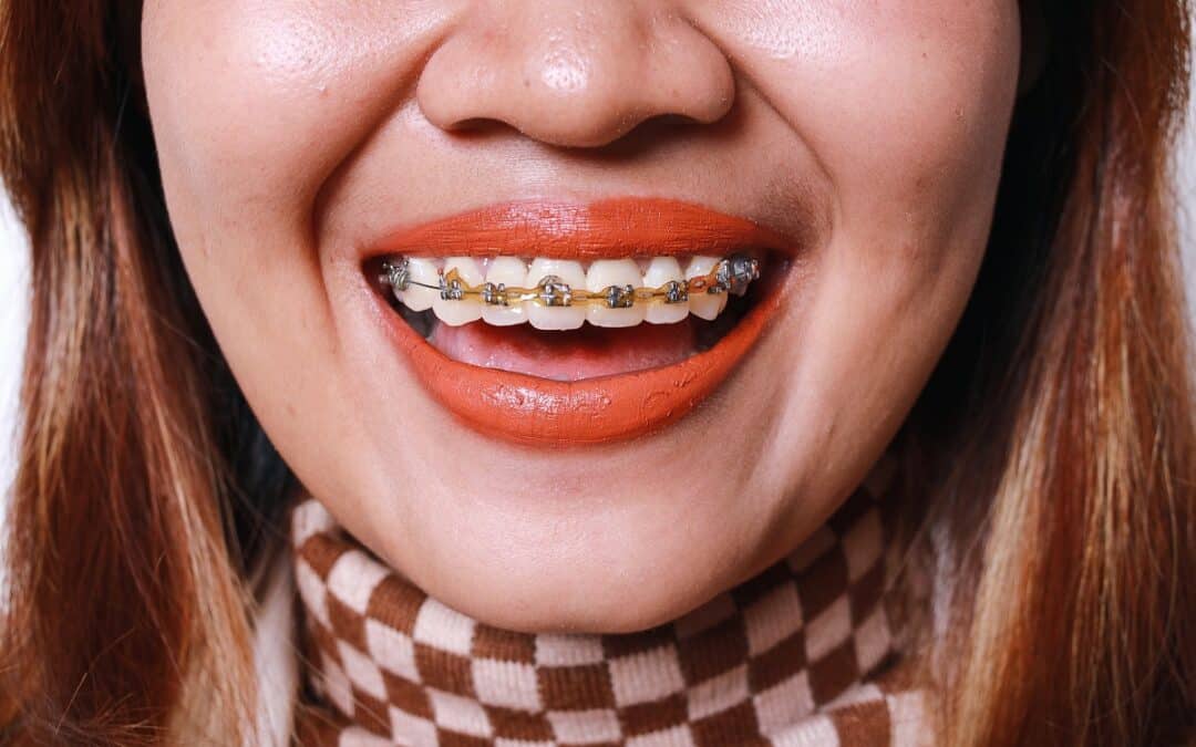 I’m in My 30s or 40s. Are Braces Still Worth It, or Did I Miss My Chance?