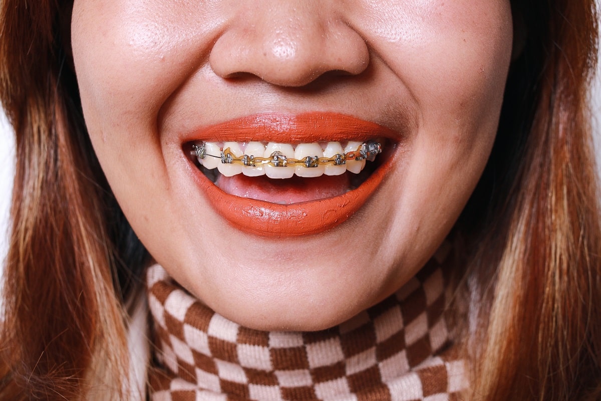 Are braces worth it adults 30s 40s