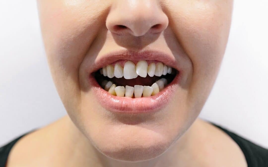 Don’t Choose an Orthodontist for Crowded Teeth Until You Check These Key Factors