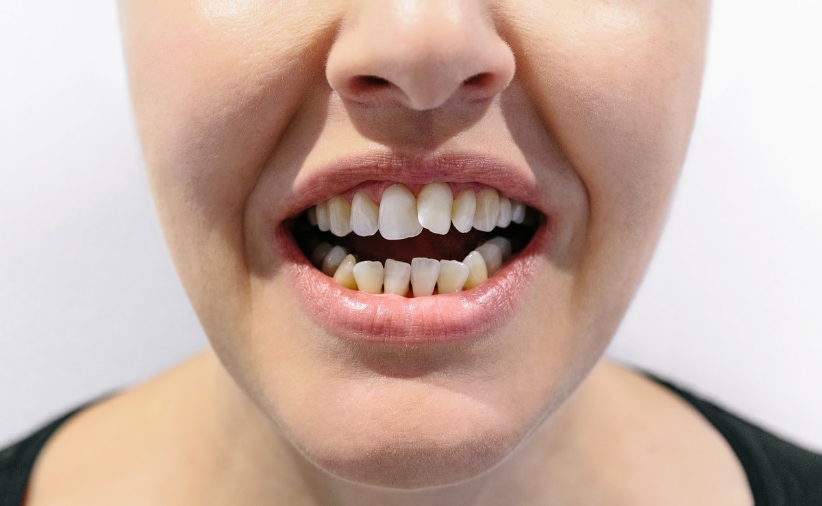 Best orthodontist crowded teeth near you in Merrick NY