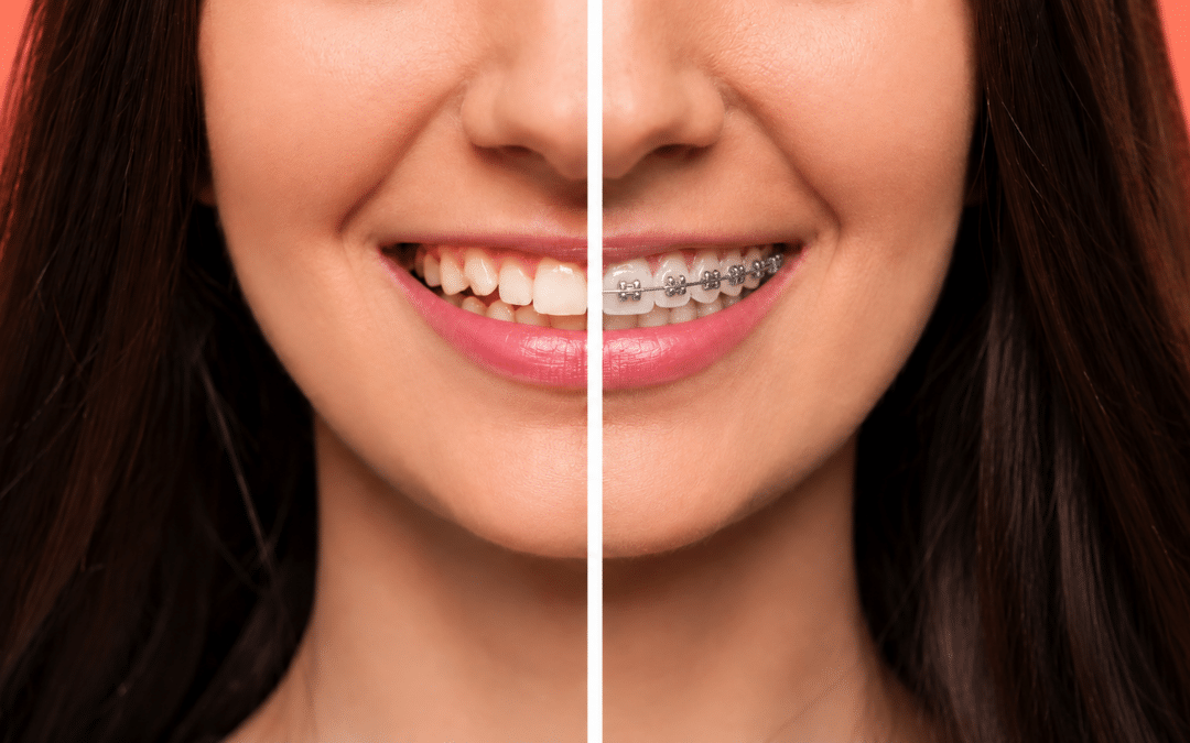 Why Are My Teeth Shifting After Braces? Causes, Solutions, and How to Protect Your Smile