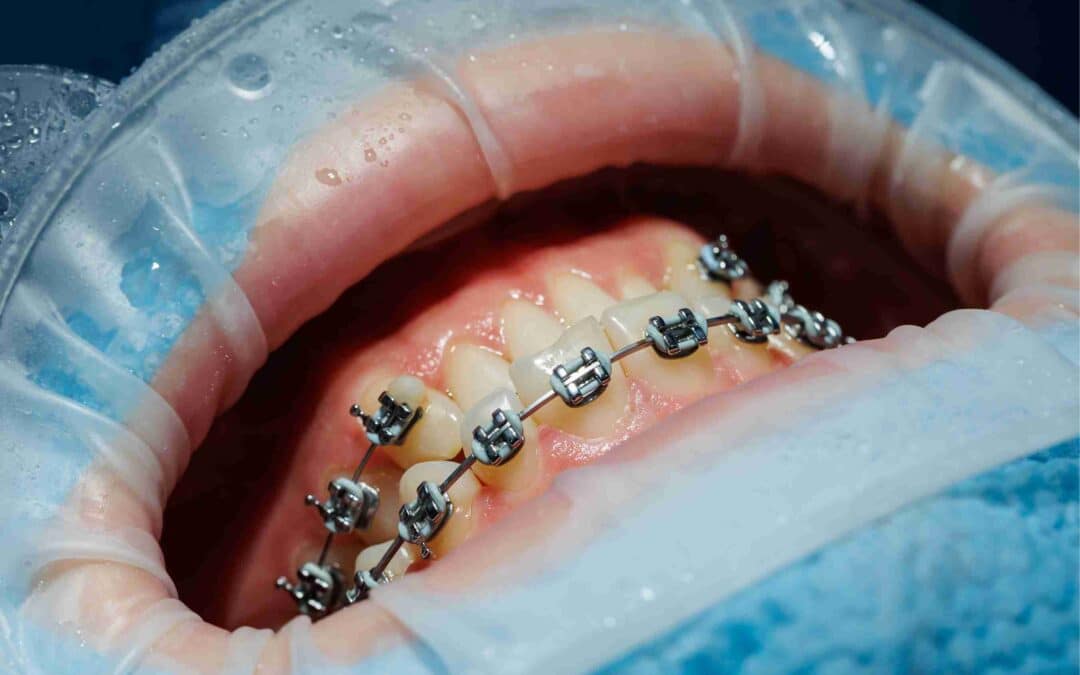 Can ZYN or Nicotine Pouches Damage Your Gums During Braces?