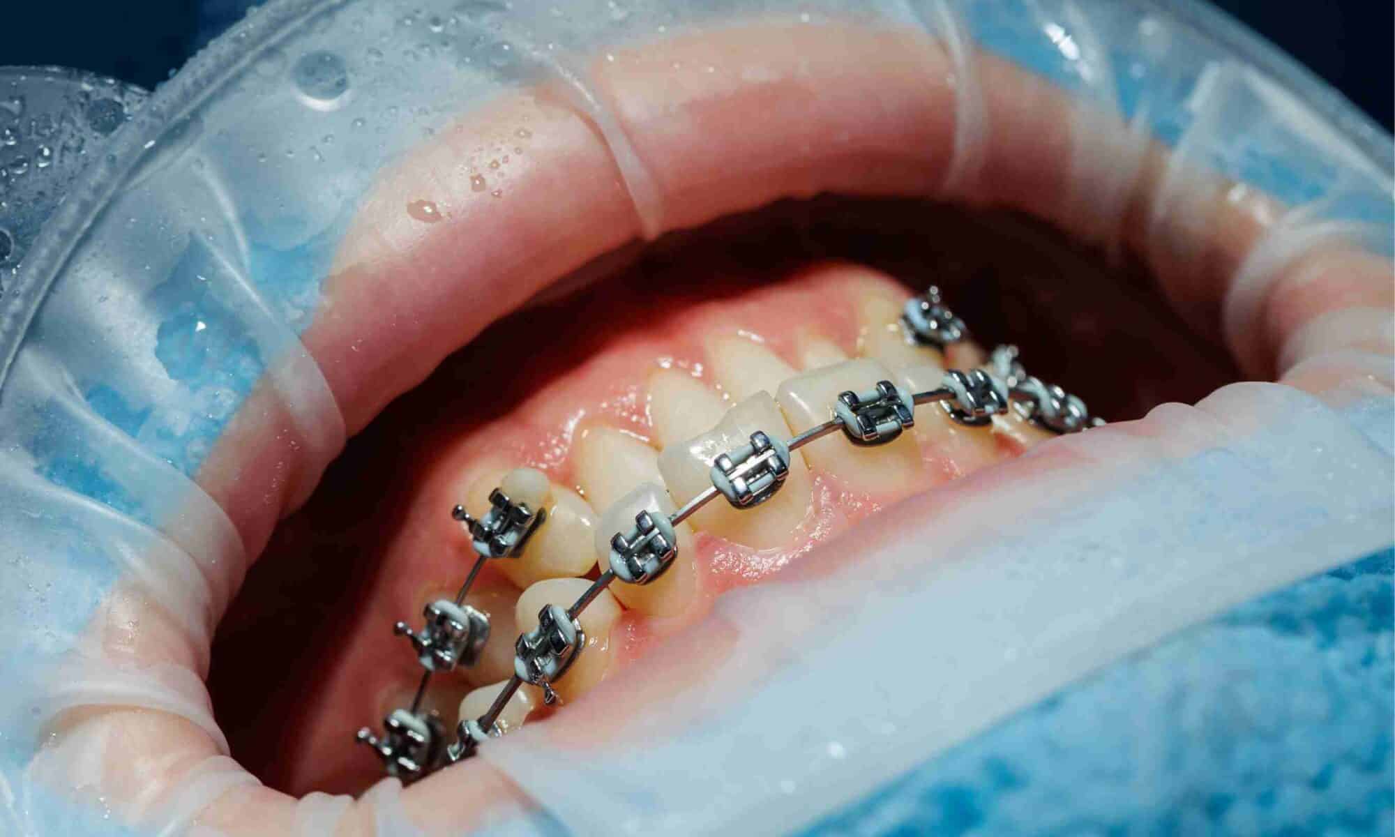 Teeth with braces during a dental examination, highlighting gum health concerns