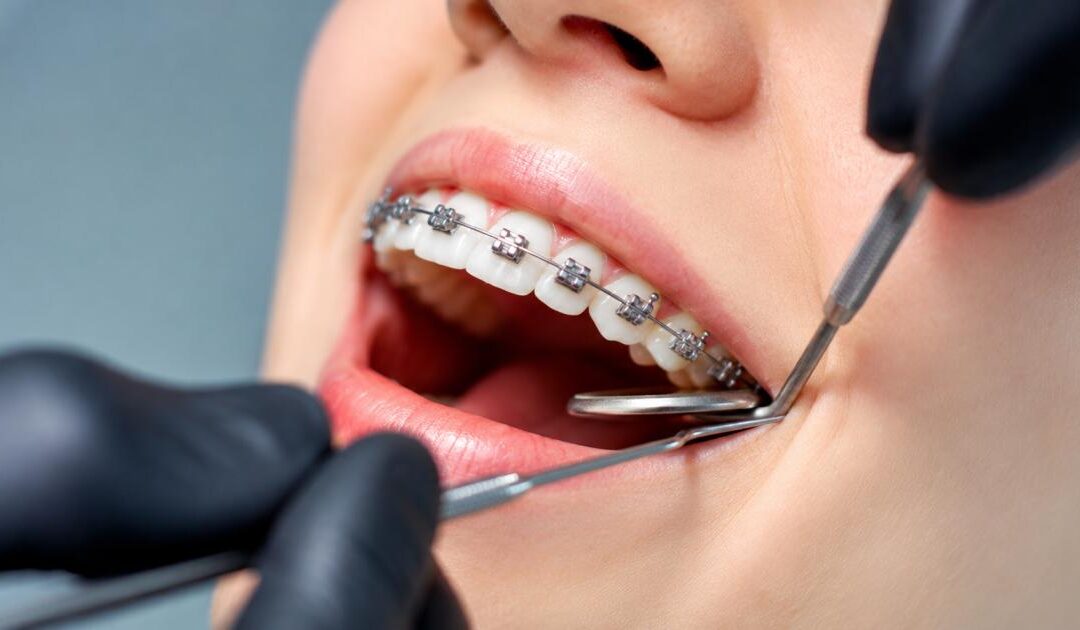 Why Is My Orthodontic Treatment Causing a Gap Between My Teeth?