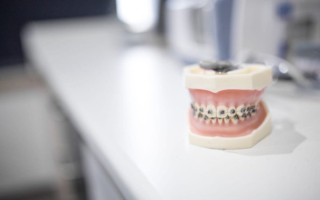 Will Your Braces Results Last Forever, or Do They Shift Back
